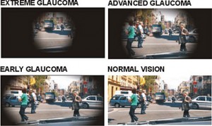 Glaucoma foto 2