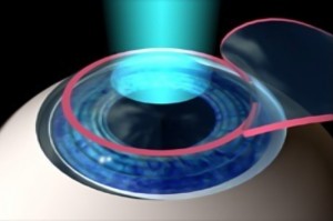 cirurgia refrativa foto 1
