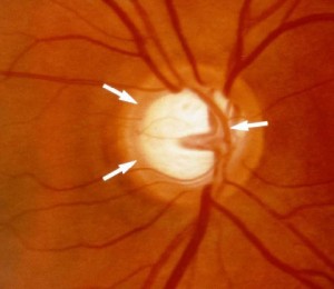 glaucoma foto 2